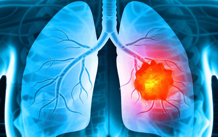 Tratamentul cancerului pulmonar cu celule mici: Ce trebuie să știe pacienții despre noile terapii și opțiunile de supraviețuire