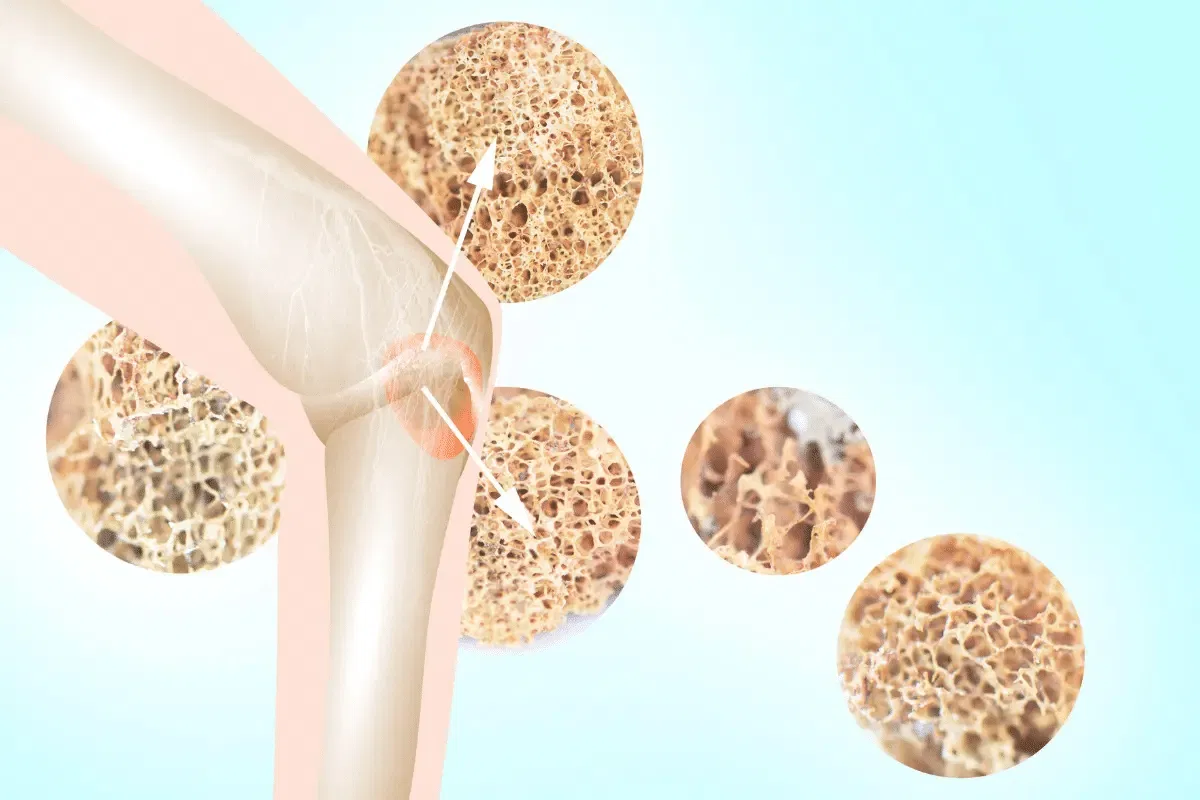 Libérate de la Osteoporosis: Descubre Estrategias Efectivas para Huesos Más Fuertes